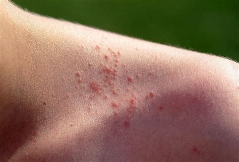 heat rash from tanning bed
